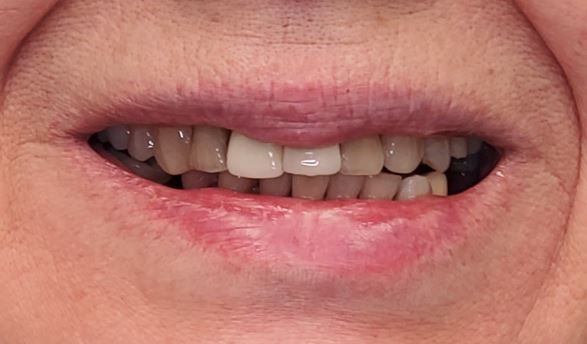 Cosmetic dentistry before treatment at Elm Ridge Implant and Family Dentistry in Killeen, TX